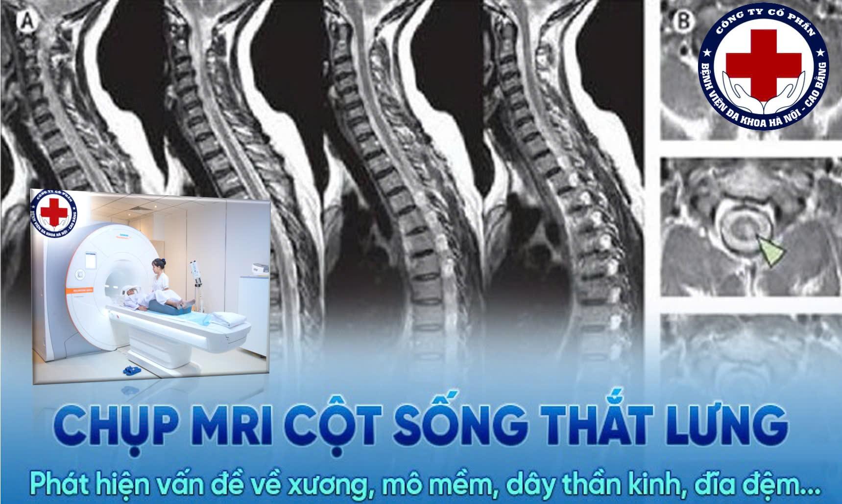 Chụp MRI cột sống, thắt lưng khi nào