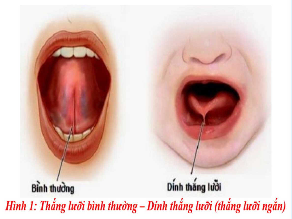 Cắt thắng lưỡi an toàn – không đau – xuất viện trong ngày tại bệnh viện Đa khoa Hà Nội – Cao Bằng