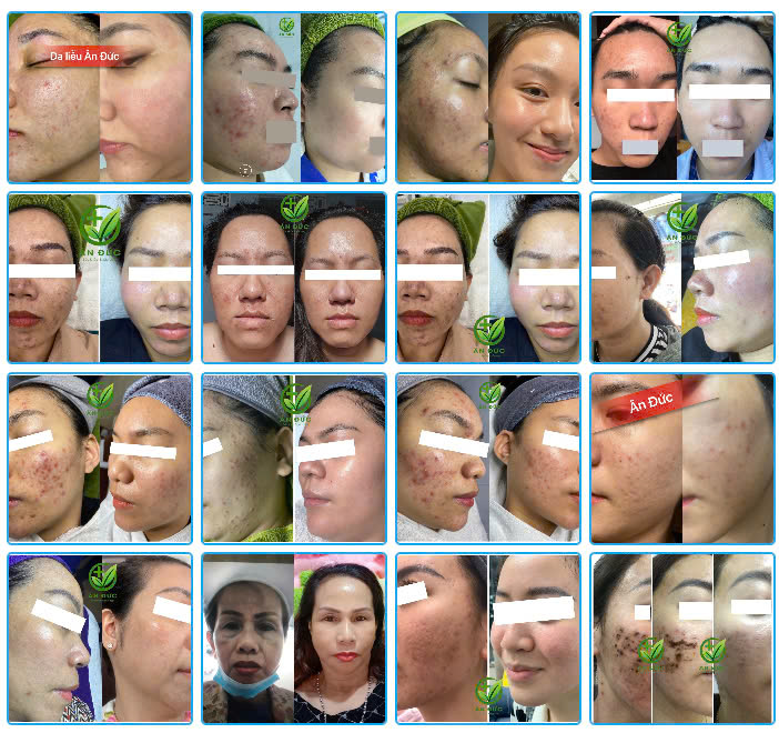 Kết quả thực tế minh chứng cho kết quả điều trị